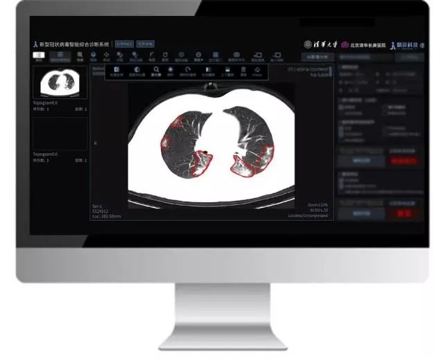 “新型冠状病毒肺炎智能辅助诊断系统”演示界面。清华大学供图
